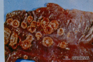  1.6.020	Ulceras botonosas con necrosis de intestino de un porcino_1