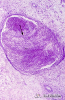 2.7.035 Histopatología de un trombo en una arteria_1