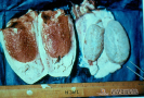2.11.002 Orquitis hemorrágica con exudado fibrinosos en los testículos de un toro (lado izquierdo) los testículos del lado derecho corresponden a un toro con inflamación unilateral_1