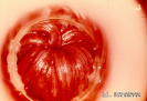 2.11.022 Exploración clínica de una cervicitis con áreas de hemorragia en una yegua Hidrosalpingitis en una vaca (observar en el tercio medio del salpinx el acumulo de trasudado que forma una pequeña bolsa que distiende las paredes del tejido) Freemartin_1