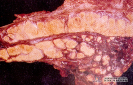  2.6.015 Neumonía tuberculosa bovina (observar las áreas de necrosis caseosa)_1