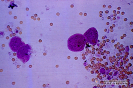 2.9.005 Microscopia de sedimento urinario. Células de epitelio de transición, eritrocitos y algunos leucocitos_1