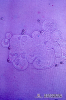 2.9.006 Microscopia del sedimento de orina de un perro con células de transición carcinomatosas en la vejiga urinaria. Grupo de células de epitelio de transición y eritrocitos adyacentes_1