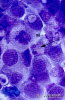 2.9.008 Células neoplasicas de epiteliuo de transición, se aprecia la mitosis (m), agrandamiento de núcleo, hipercromía y agrandamiento del nucléolo, con la flecha se compara con el tamaño del leucocito._1