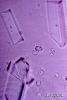 2.9.023 Sedimento urinario. Cristales de fosfato rodeados por eritrocitos crenados_1