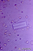  2.9.034 Sedimento urinario. Cristal de fosfato, eritrocitos y leucocitos_1