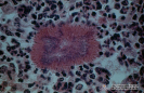 2.1.044 44 Actinomicosis en bovino (microscopia del corte histopatológico en el que observa la colonización por actynomices bovis del tejido oseo del maxilar superior)_1