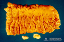 2.5.013 Enteritis con hiperplasia de la pared y mucosa intestinal, en la parte inferior se observan dos nódulos con necrosis caseosa_1