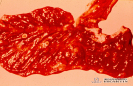    2.5.044 Ulceras en forma de botón en la mucosa intestina_1