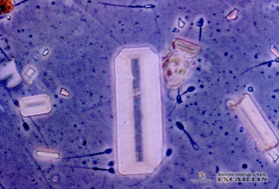 2.9.026 Sedimento urinario. Cristales de fosfato y espermatozoides (microscopia de contraste de fase)_1