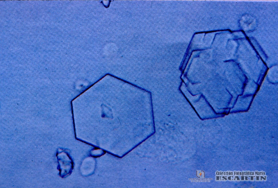 2.9.029 Sedimento urinario. Cristales de cistina rodeados por leucocitos_1